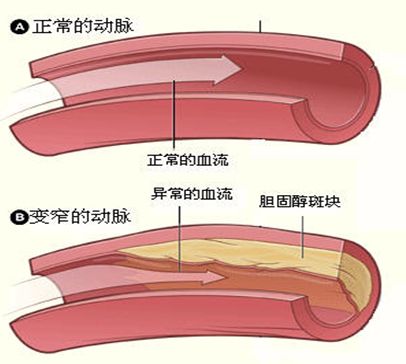 動脈粥樣硬化補(bǔ)硒